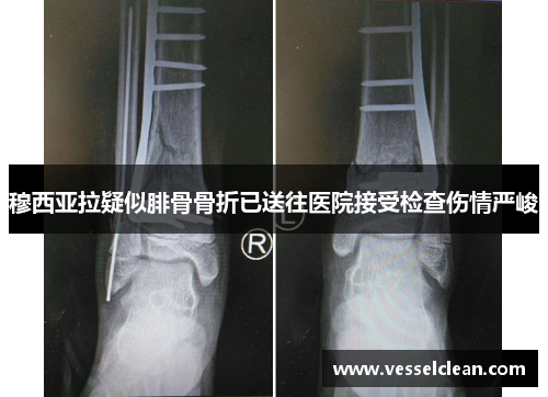 穆西亚拉疑似腓骨骨折已送往医院接受检查伤情严峻